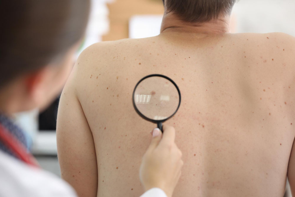 Understanding Melanoma and the Importance of Testing