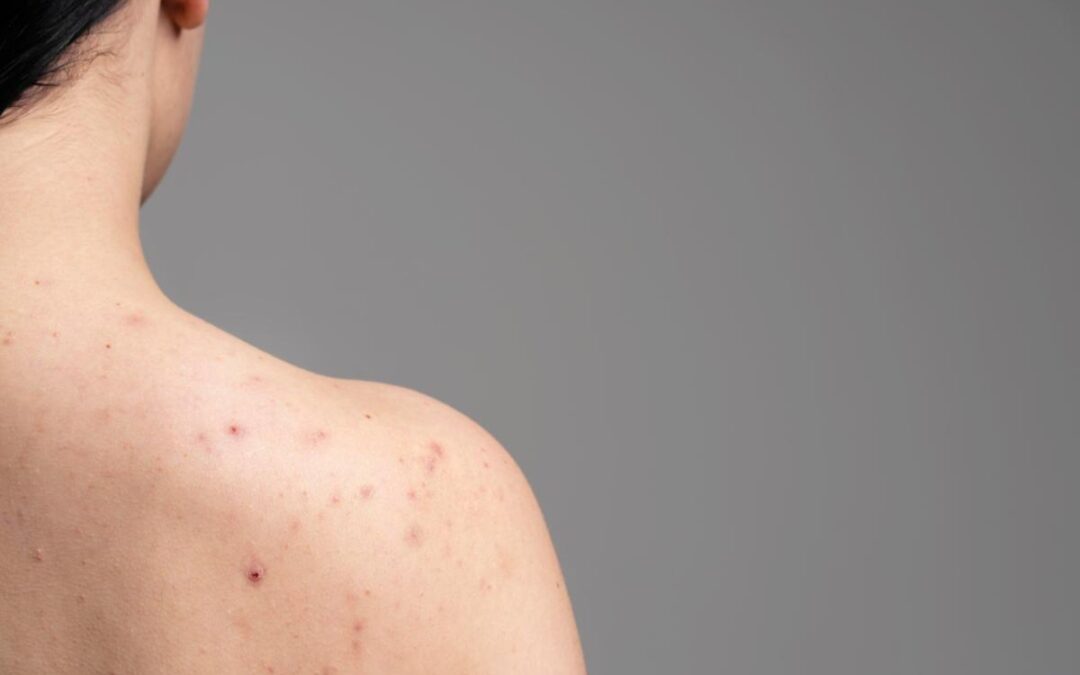 Four Reasons Why You May Need a Skin Biopsy