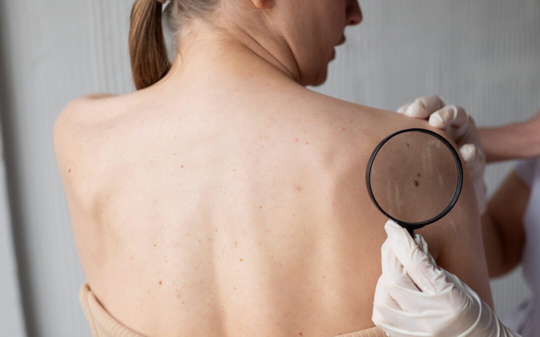 Early Detection of Melanoma: What You Need to Know