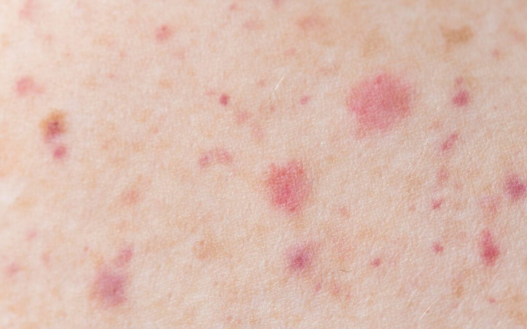 Atopic Dermatitis: Understanding and Treating This Skin Condition