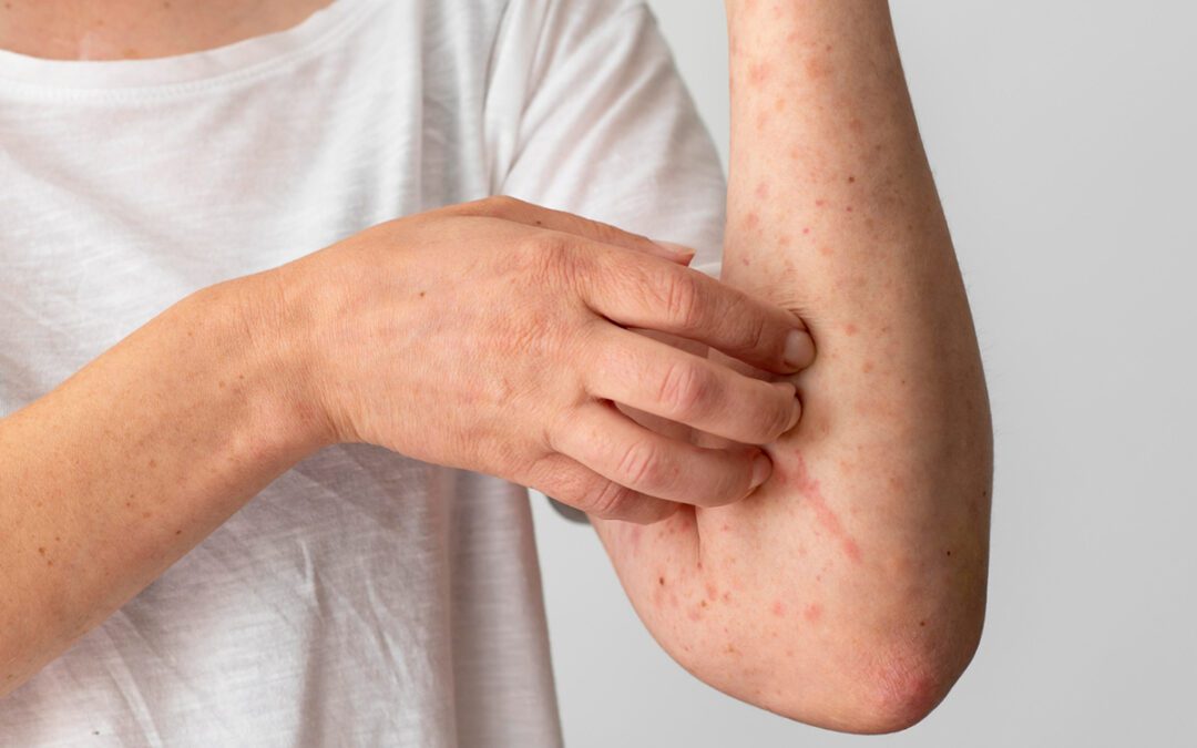 Clear Cell Acanthoma: Symptoms, Diagnosis, and Treatment